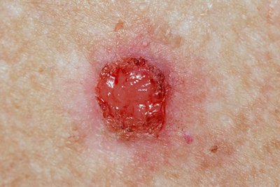 Close-up image of basal cell carcinoma on human skin